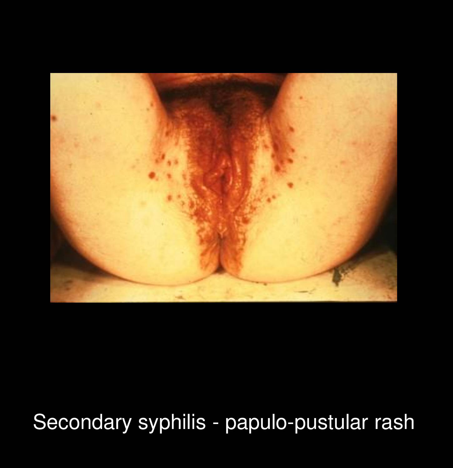 Tertiary syphilis gummatous lesion on leg showing destructive nodular ulcerative lesion with punched-out appearance and serpiginous border